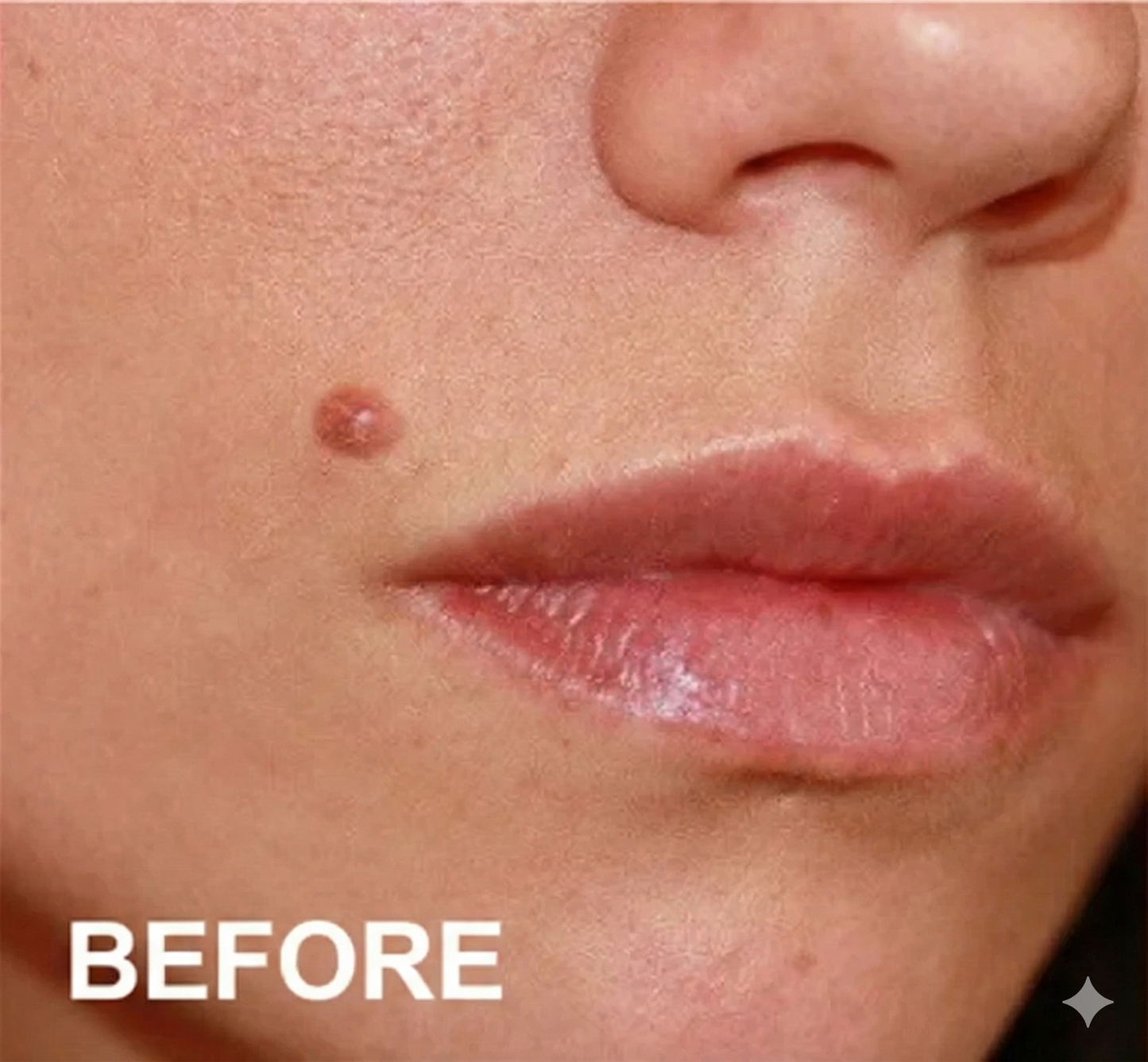 Flex Microneedle Mole Removal Patch – Removes in 5 Days Without Scarring