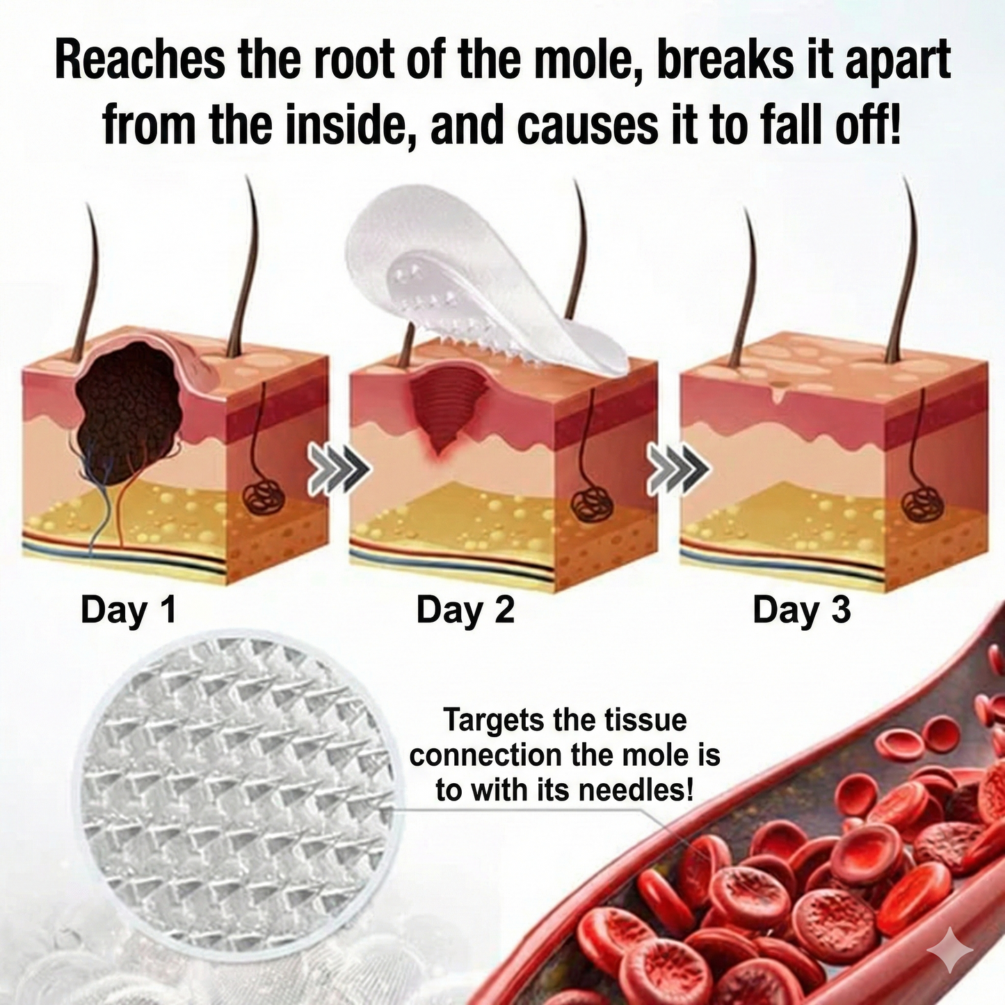 Flex Microneedle Mole Removal Patch – Removes in 5 Days Without Scarring
