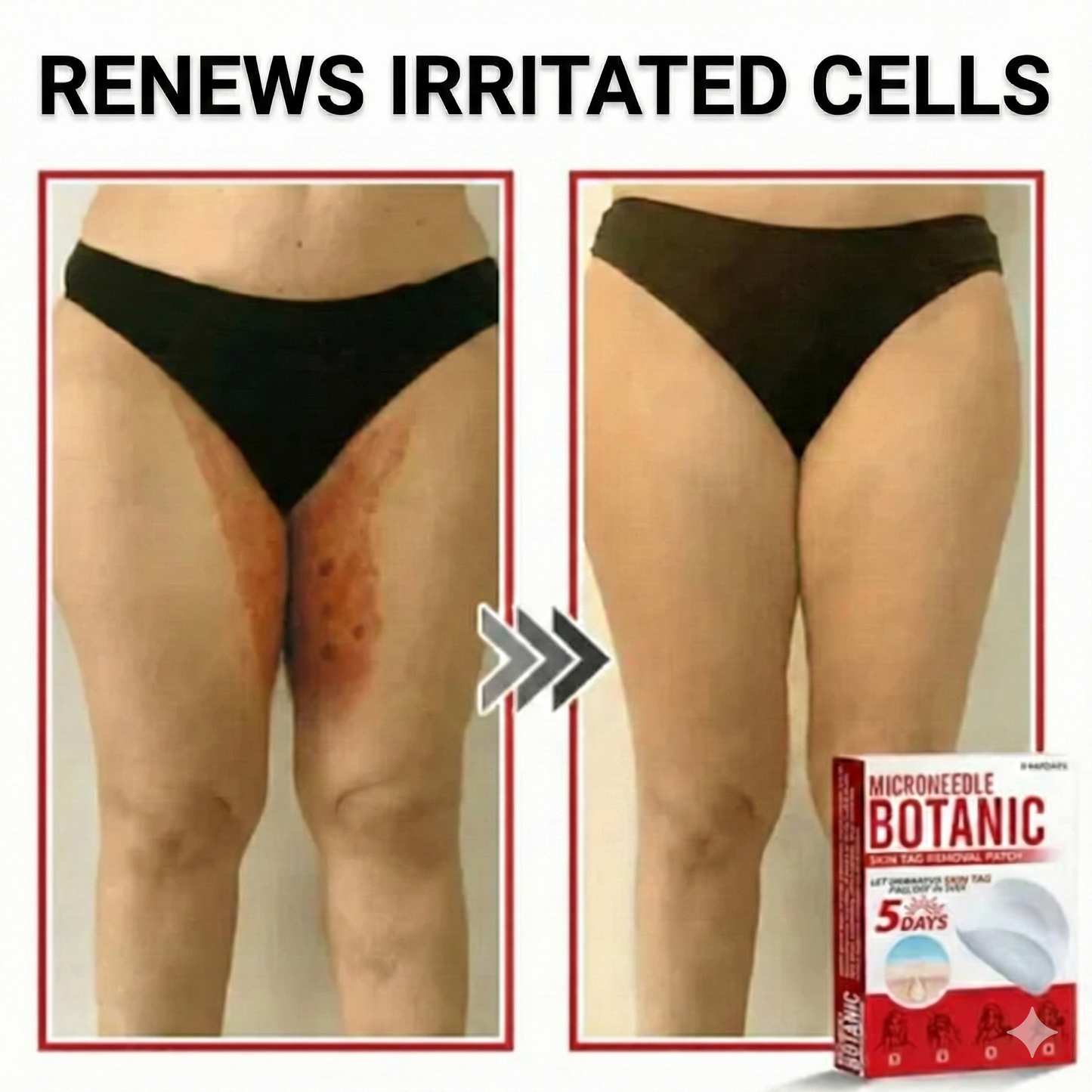 Flex Microneedle Mole Removal Patch – Removes in 5 Days Without Scarring