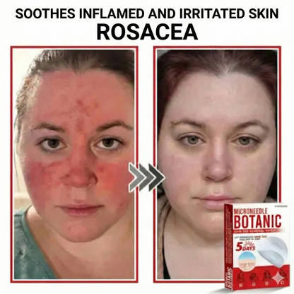 Flex Microneedle Mole Removal Patch – Removes in 5 Days Without Scarring