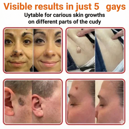 Flex Microneedle Mole Removal Patch – Removes in 5 Days Without Scarring