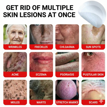 Flex Microneedle Mole Removal Patch – Removes in 5 Days Without Scarring